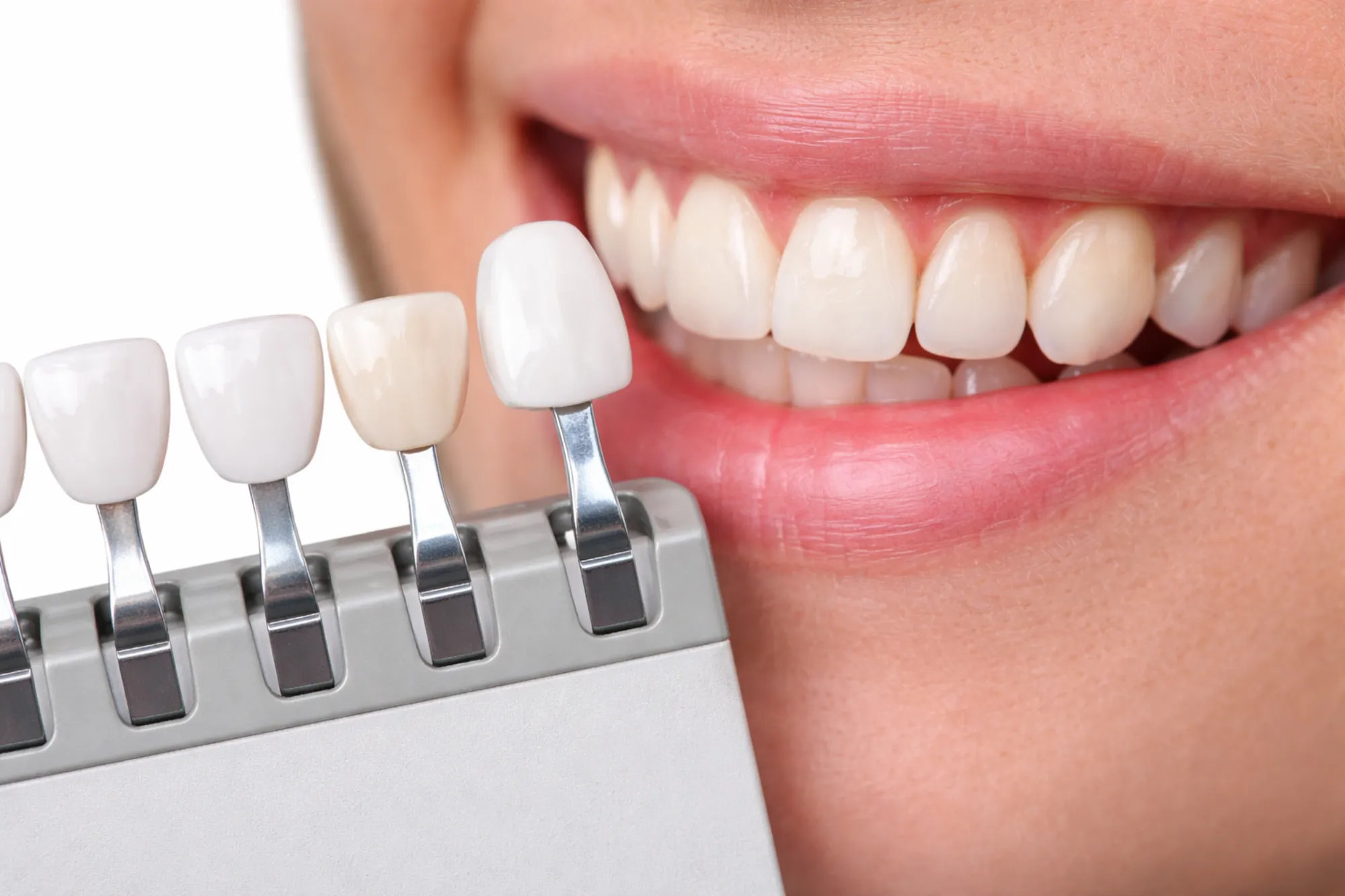Porcelain Veneers
