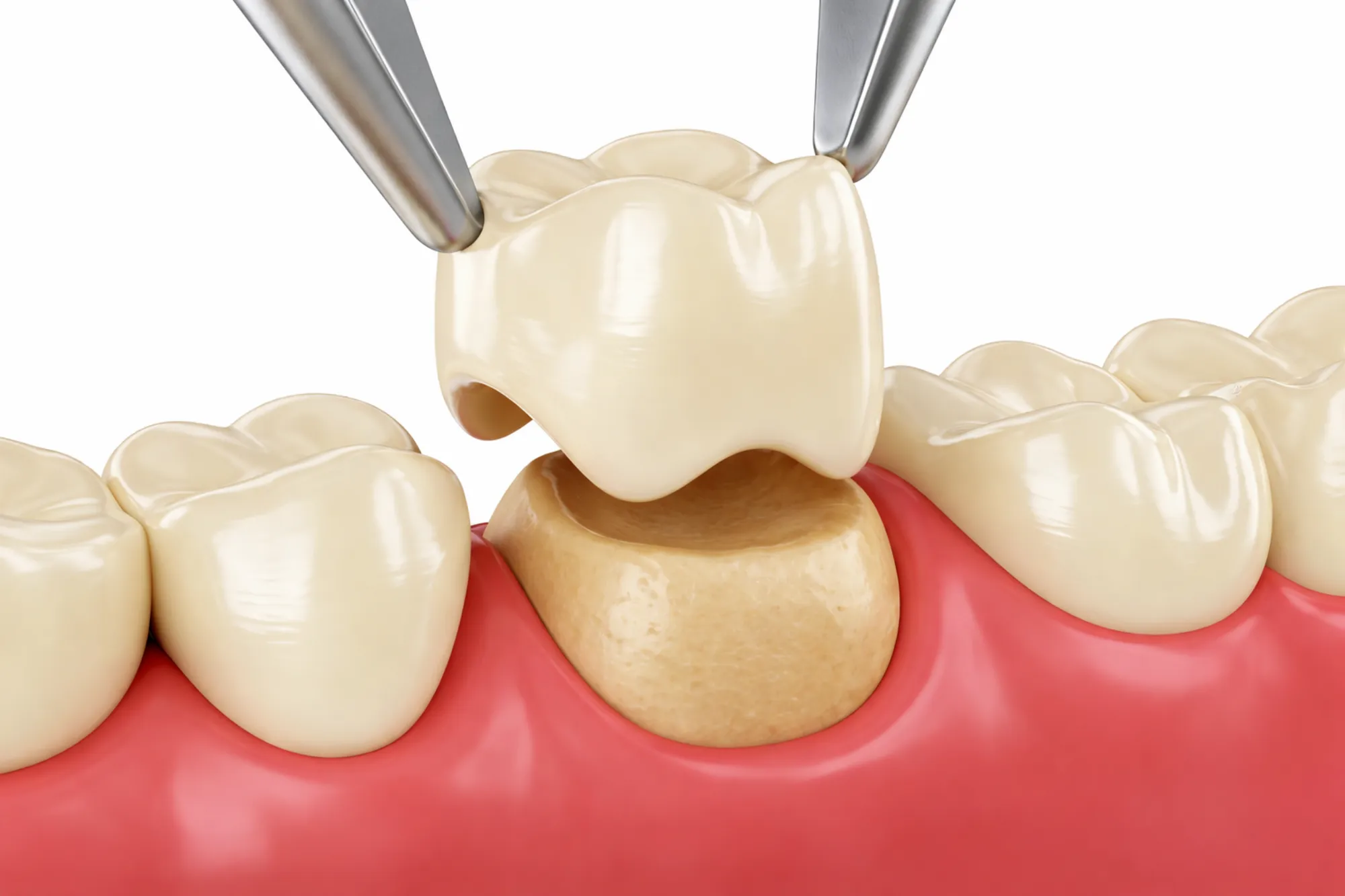Zirconia Crowns